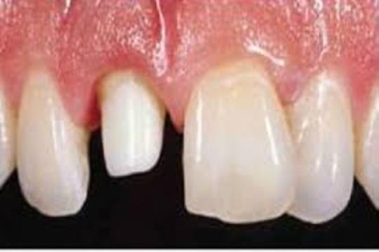 Dentures