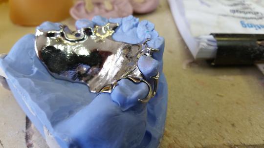 Anterior Splints