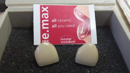 Implant dentures